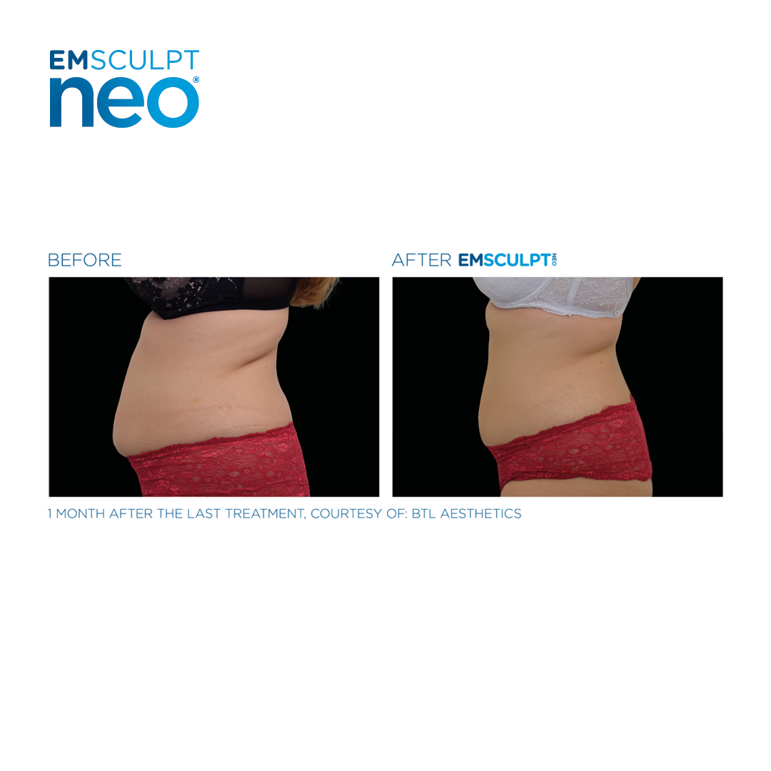 EMSCULPT clinical result