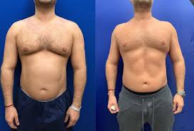 EMSCULPT clinical result