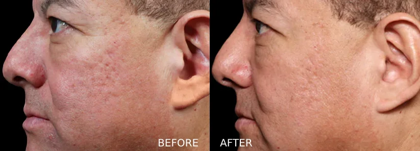 EXION clinical result