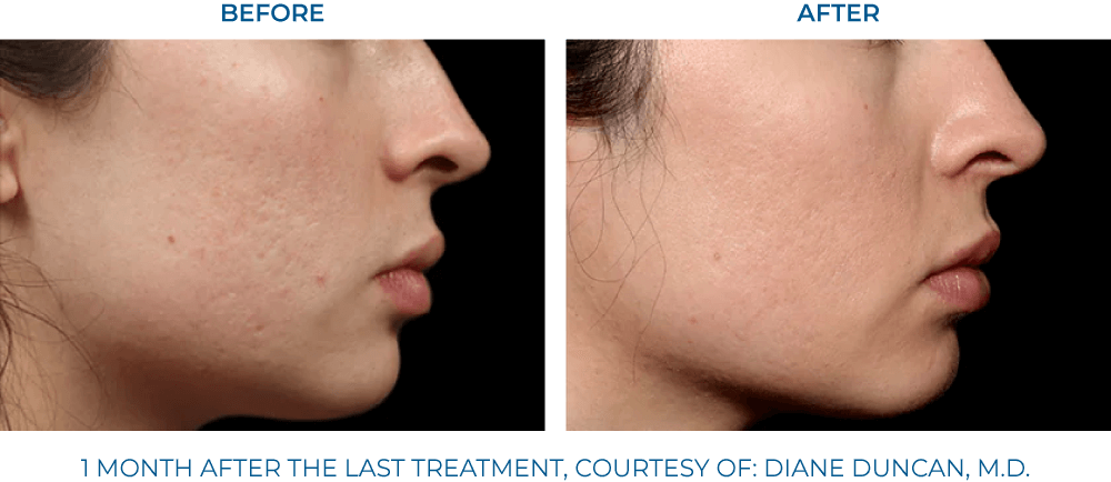 EXION clinical result