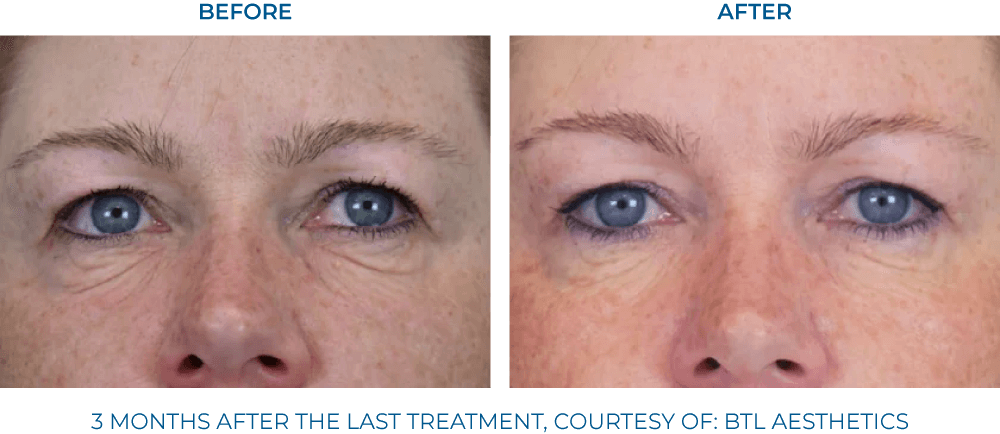 EXION clinical result