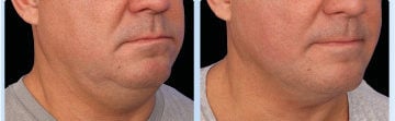 EMFACE clinical result