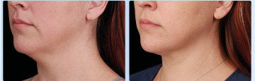 EMFACE clinical result