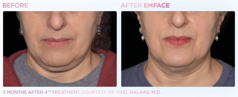 EMFACE clinical result