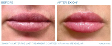 EXION clinical result