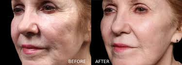 EXION clinical result