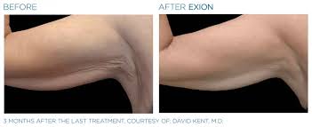 EXION clinical result