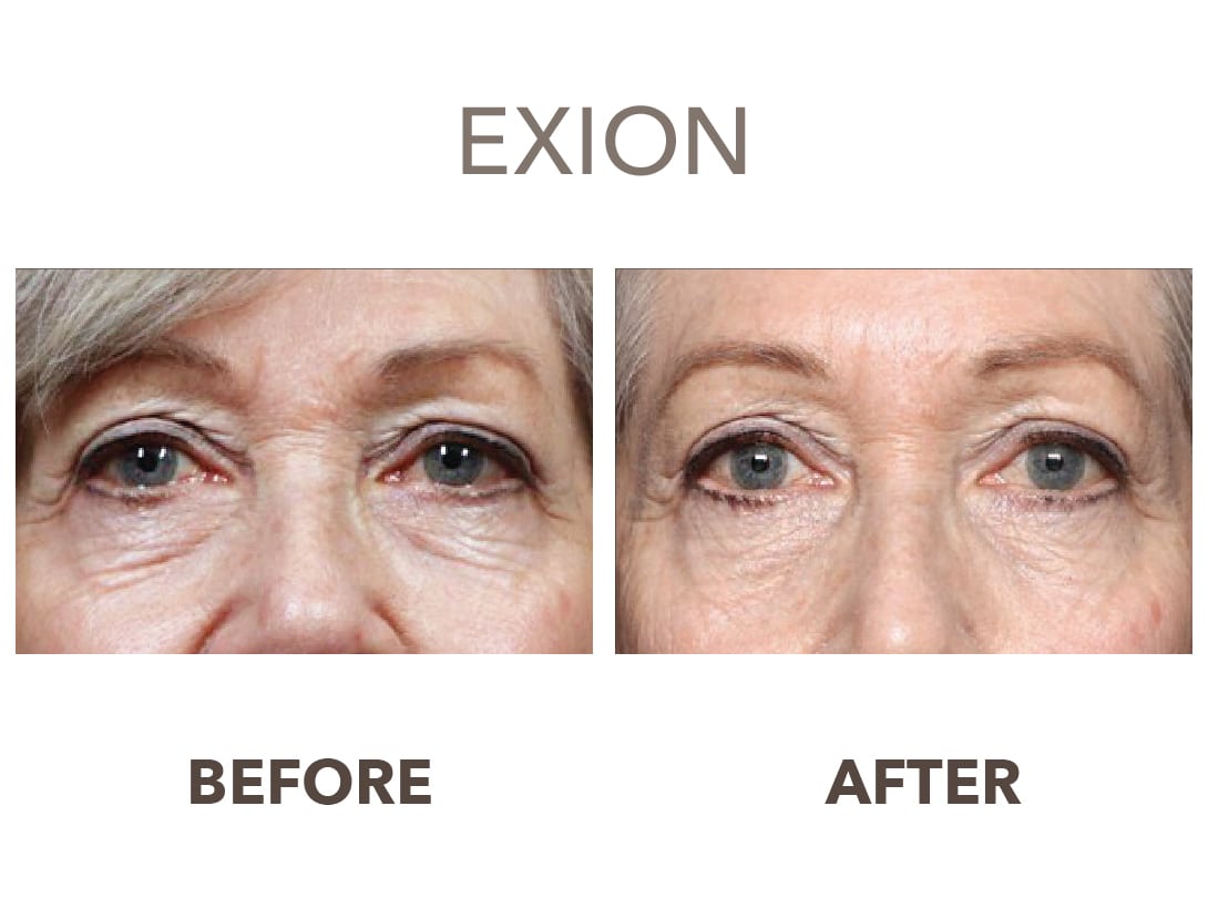 EXION clinical result