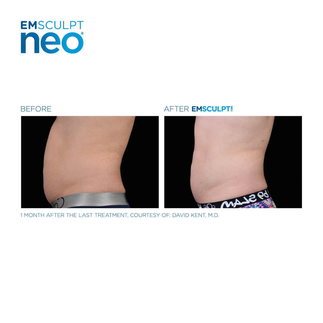 EMSCULPT clinical result