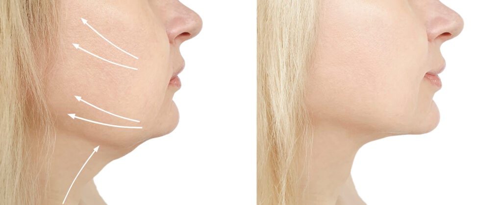 EMFACE clinical result
