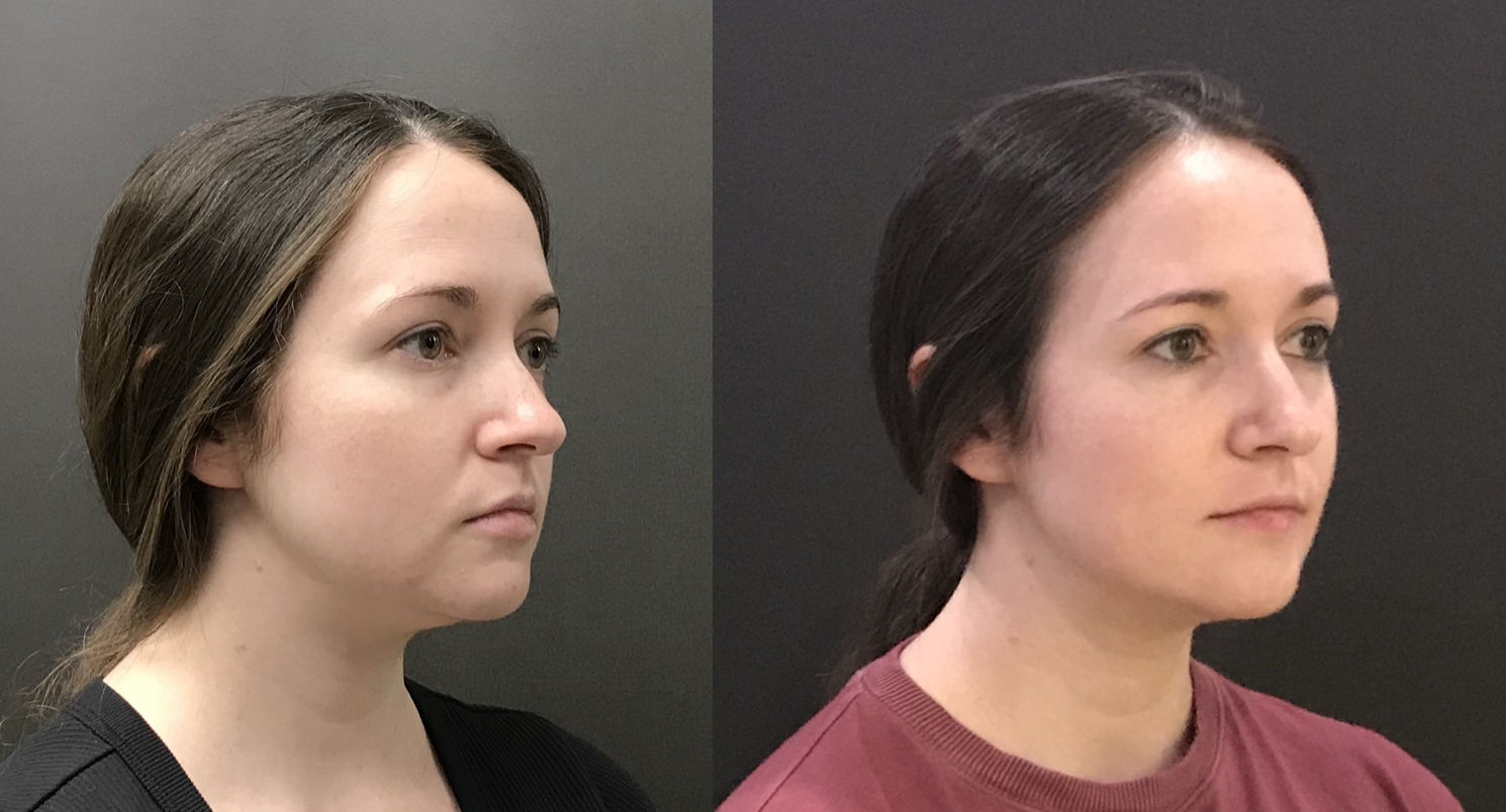 EMFACE clinical result
