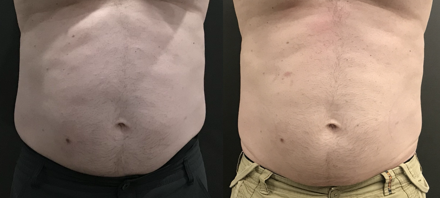 EMSCULPT clinical result