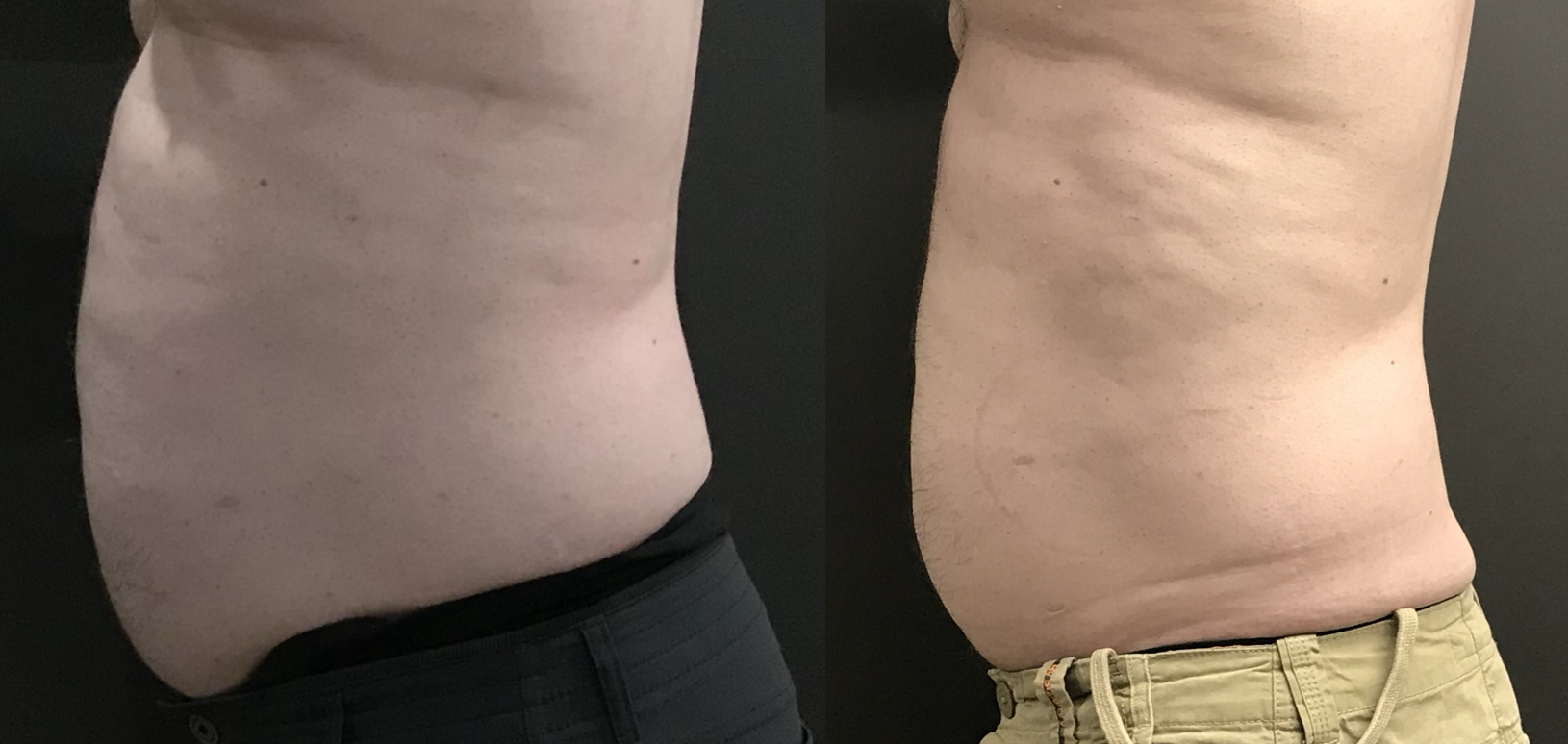 EMSCULPT clinical result