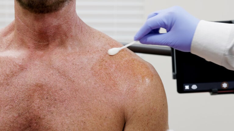 Shoulder prepped with antiseptic before an injection